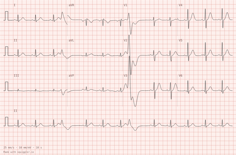 Ventricular ectopics — synthetic ECG on millimetre paper