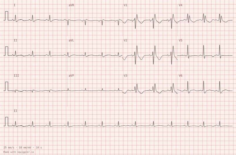 Right bundle branch block — synthetic ECG on millimetre paper