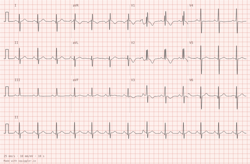 Right ventricular hypertrophy — synthetic ECG on millimetre paper