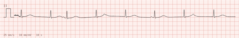 Junctional escape over a slow sinus — synthetic ECG on millimetre paper