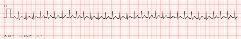 SVT — synthetic ECG on millimetre paper