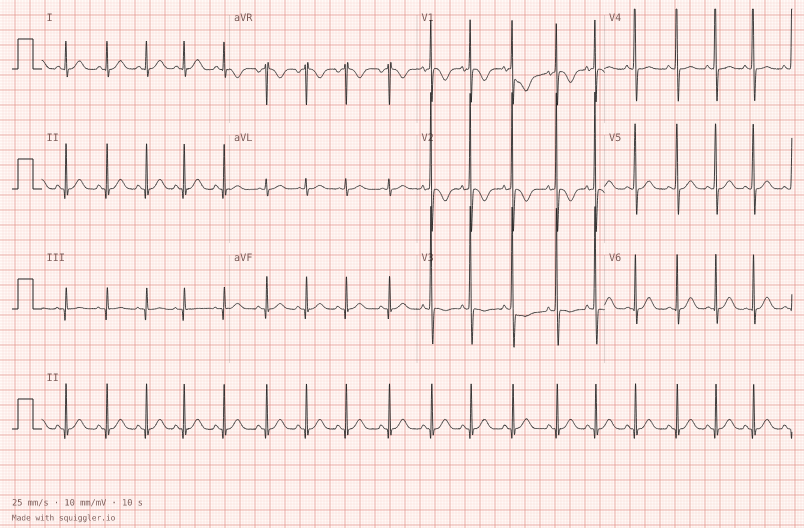 Two-year-old — synthetic ECG on millimetre paper