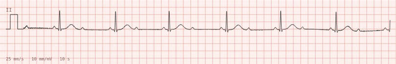 2:1 AV block — synthetic ECG on millimetre paper