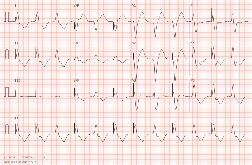 Ventricular pacing — synthetic ECG on millimetre paper