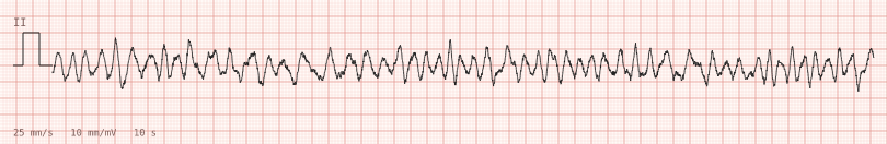 Ventricular fibrillation — synthetic ECG on millimetre paper
