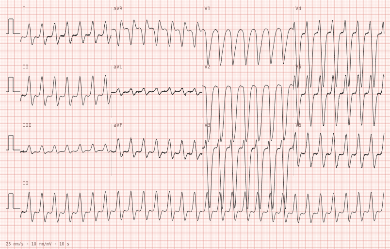 Monomorphic VT — synthetic ECG on millimetre paper