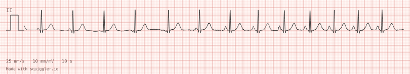 Wandering atrial pacemaker — synthetic ECG on millimetre paper