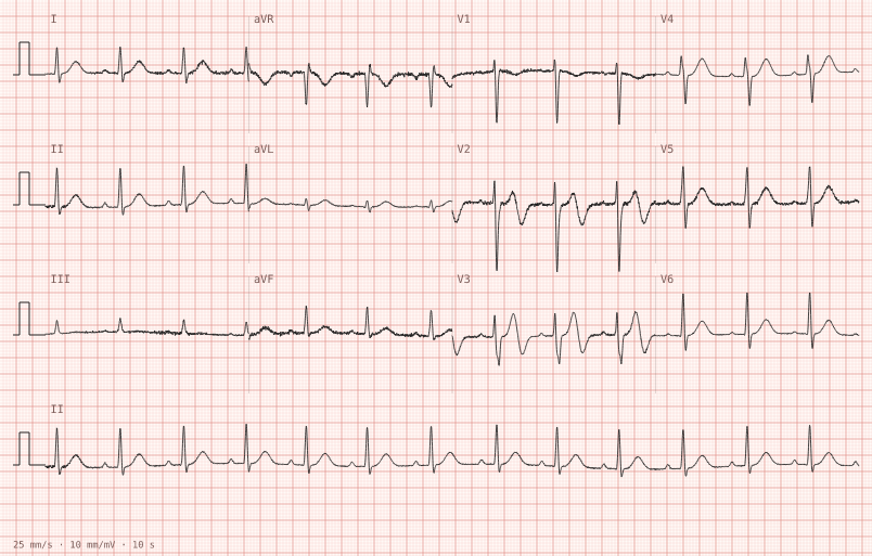 Wellens type A — synthetic ECG on millimetre paper