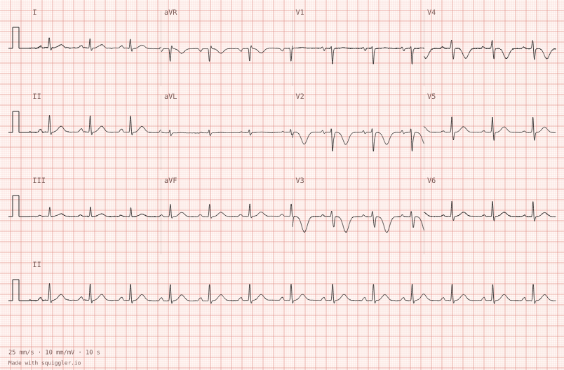 Wellens type B — synthetic ECG on millimetre paper