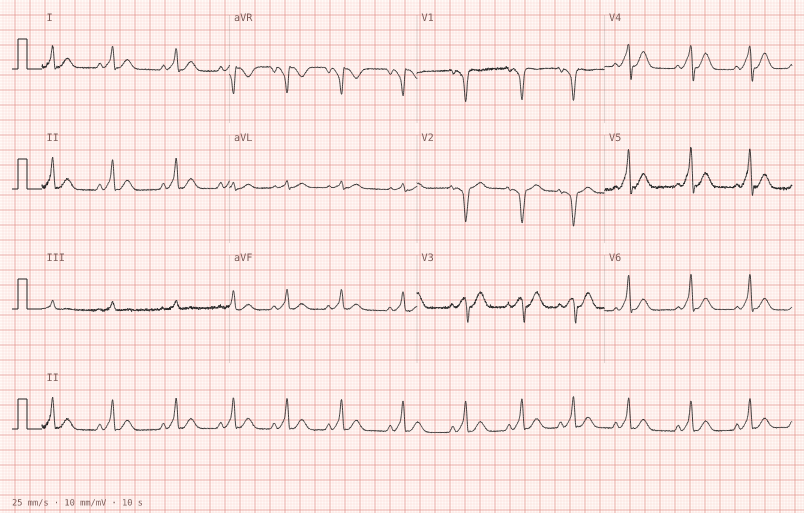 WPW pre-excitation — synthetic ECG on millimetre paper